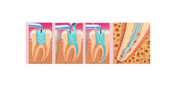 Igły do przemywań 0,3x25 Medical 10szt - 2 otwory!