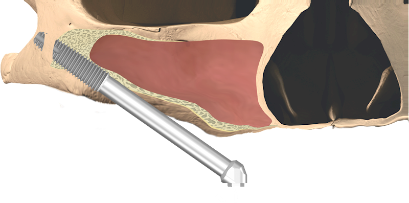Implant 55° Oncology 4x47.5N