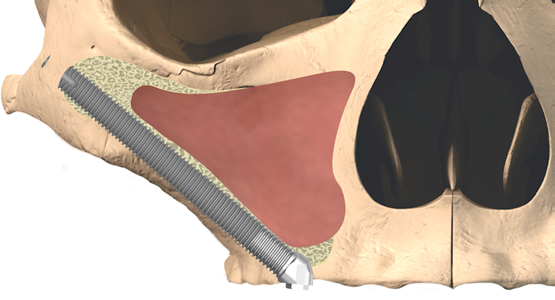 Implant zygomatyczny 55° ZYG 4x40 mm