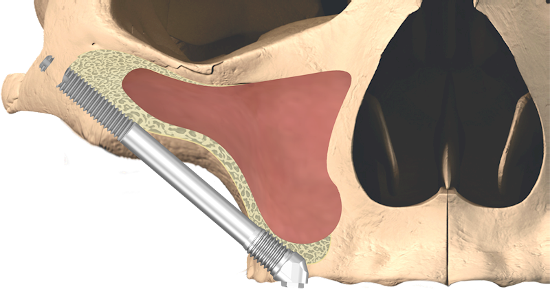 Implant External Hex Zygan 4 x 50mm